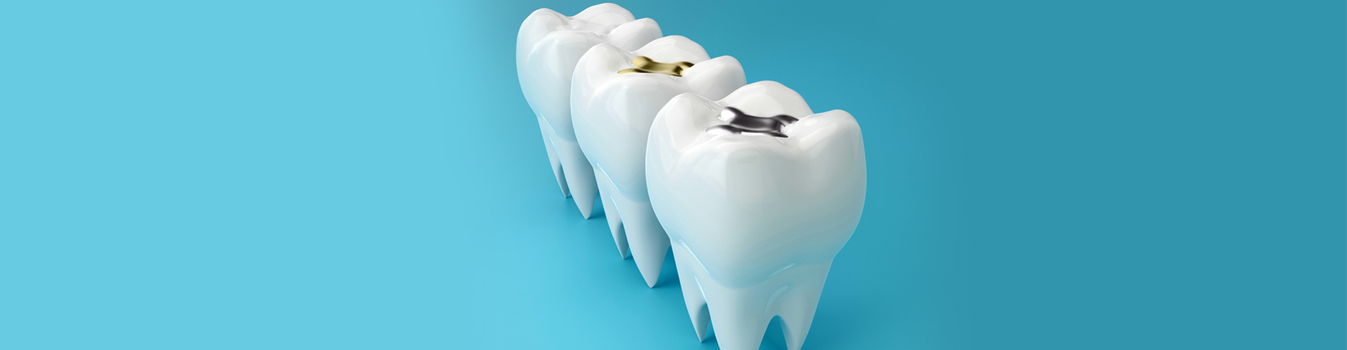 Dental Fillings