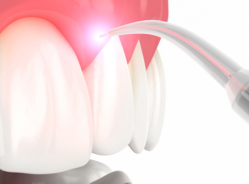 Fotona Laser Dentistry