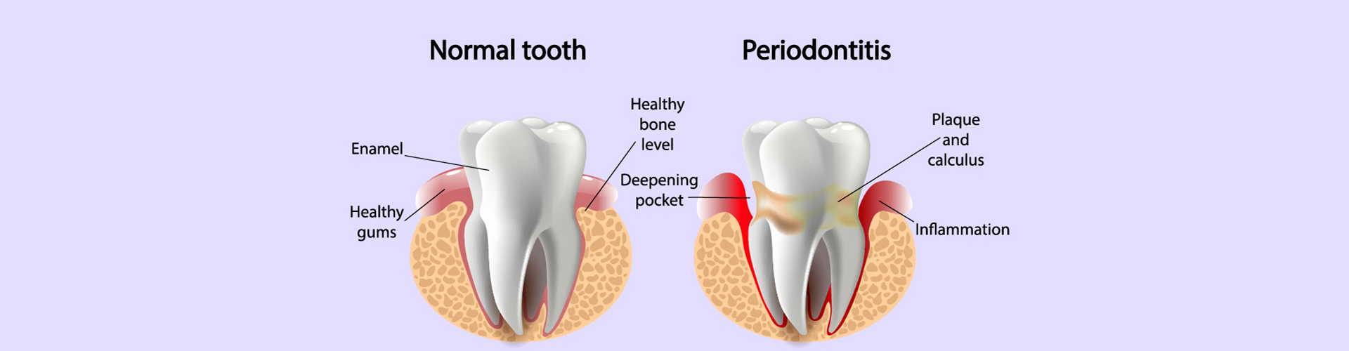 Periodontal Treatment