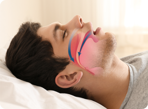 Sleep Apnea Treatment