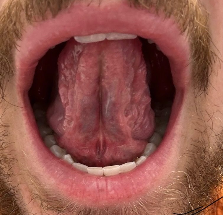 Tongue Tie After